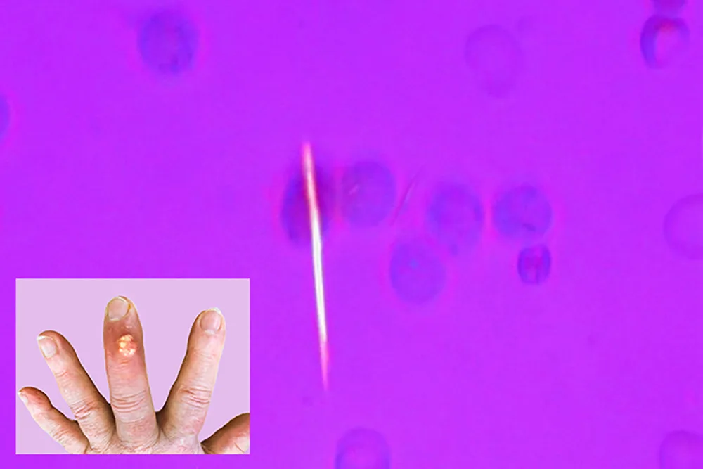Gichtkristalle unter dem Polarisationsmikroskop, kleines Bild: Hand mit Gichtknoten